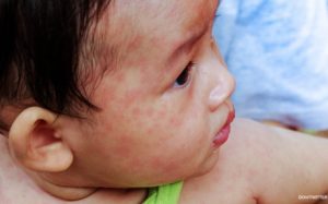 How much should you spend to treat and prevent measles?