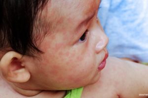 How much should you spend to treat and prevent measles?